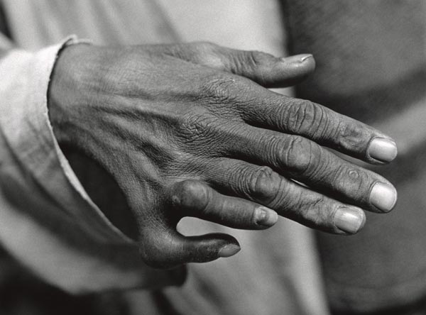 Sadhu with six fingers and six toes fingers